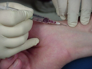 Arteriyel Kan Gazı Özellikleri ve Faydaları Nelerdir? Arteriyel Kan Gazı Özellikleri ve Faydaları Nelerdir?